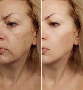 Use fillers today to enhance your looks 